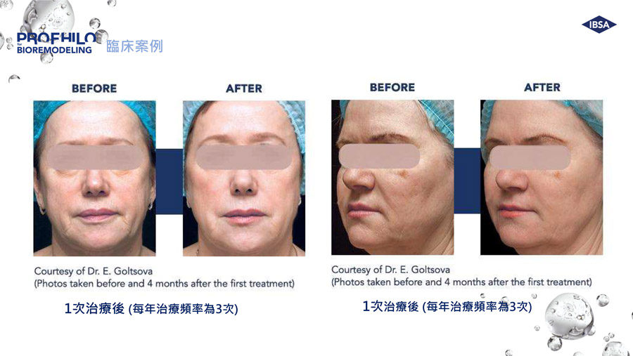 逆時針（Profhilo®）效果