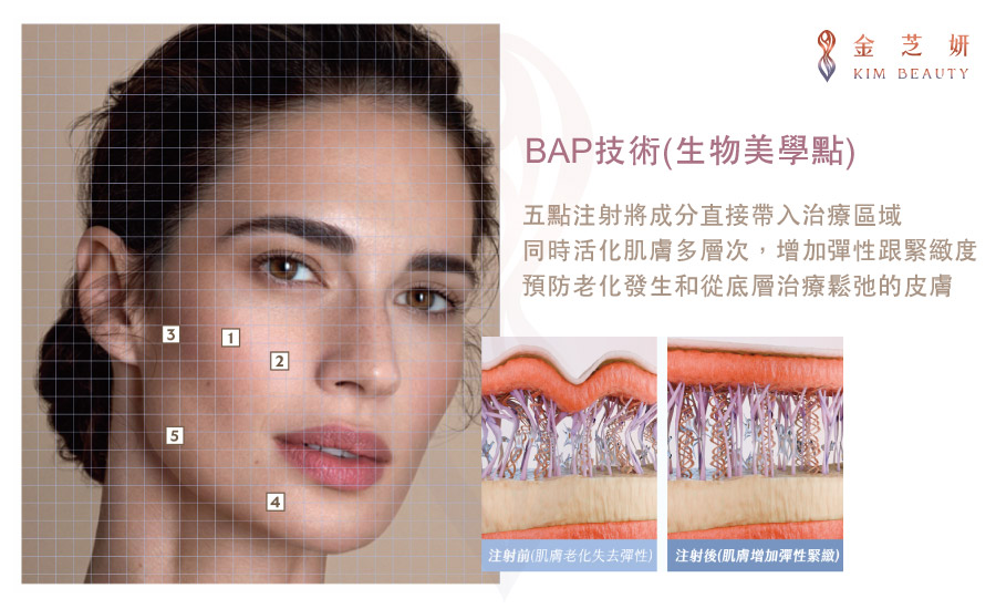 逆時針（Profhilo®）注射部位｜BAP精選點位技術：BAP臉部5點拉提