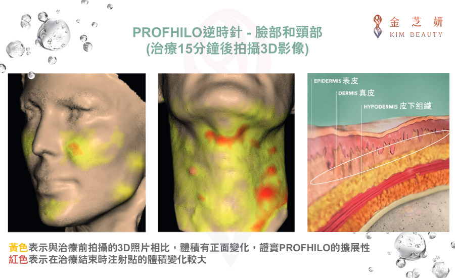 逆時針（PROFHILO® 璞菲洛）治療15分鐘後的3D影響：逆時針擴展性佳