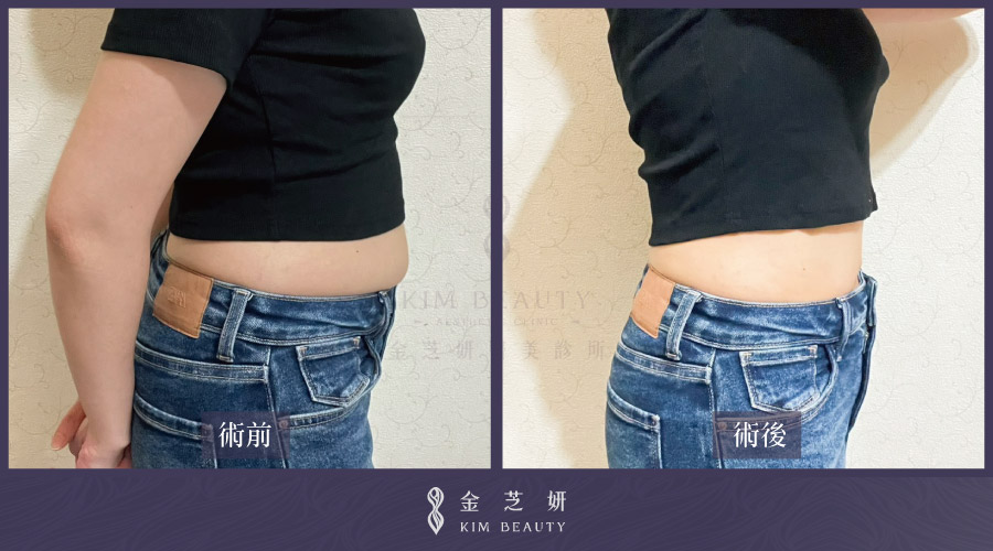 腹部抽脂案例：before & after（音浪脂雕LSSA，腹部環抽）