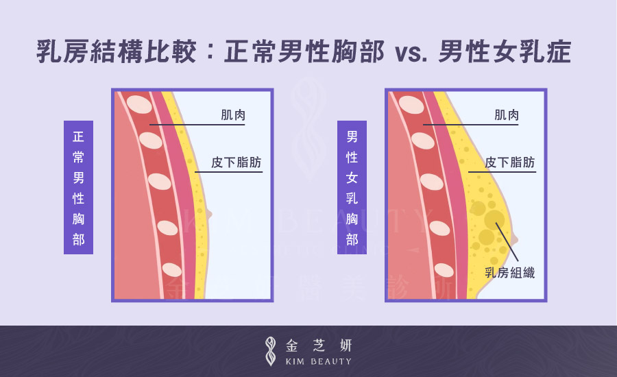 乳房結構比較：正常男性胸部vs.男性女乳症 金芝妍醫美診所