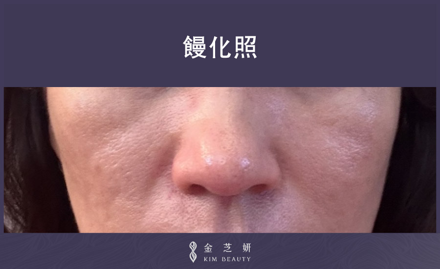 饅化臉案例01