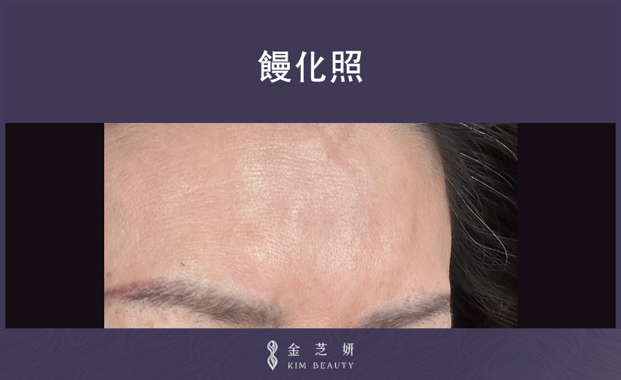 饅化臉案例03