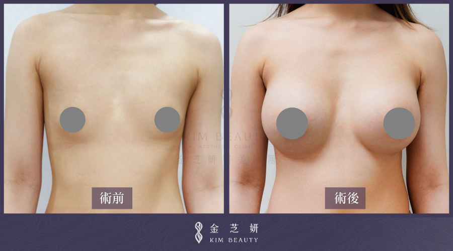 珍珠波隆乳效果：before & after 術前術後比較