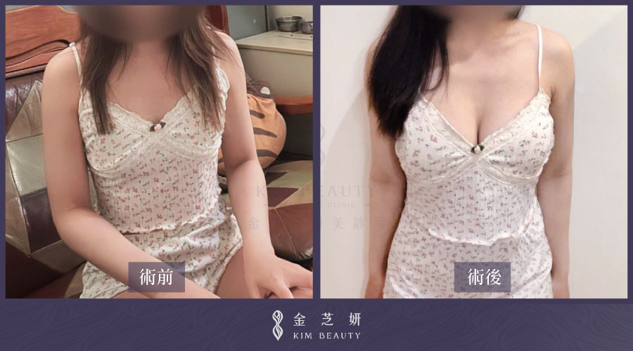 珍珠波隆乳效果：before & after 術前術後比較