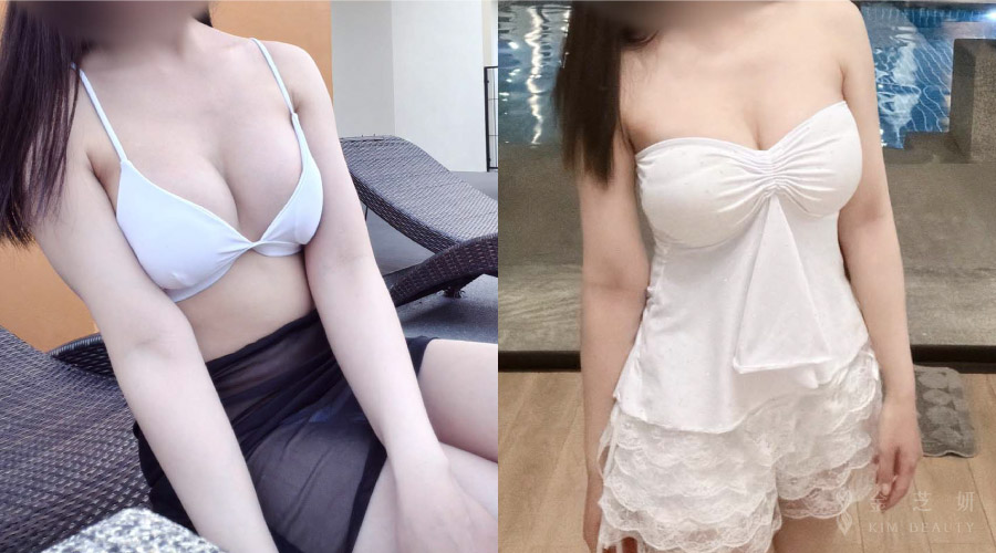 珍珠波隆乳術後：穿泳衣或低胸衣服也更有自信