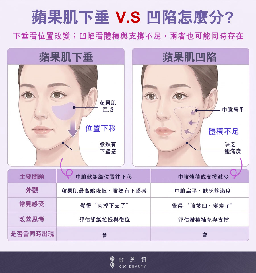 蘋果肌下垂和凹陷怎麼分?比較蘋果肌位置下移與中臉體積不足的差異