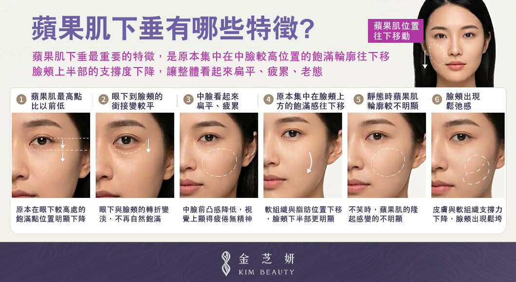 蘋果肌下垂有哪些特徵?包含蘋果肌位置下移、中臉凹陷、法令紋加深與臉頰鬆弛