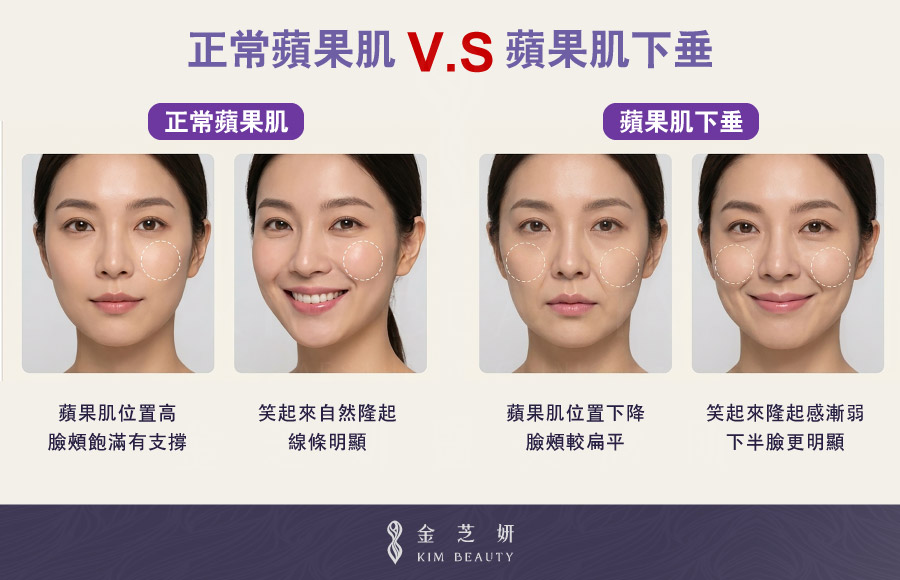 正常蘋果肌與蘋果肌下垂比較圖,顯示蘋果肌位置下降後臉頰變平、微笑時隆起感減弱