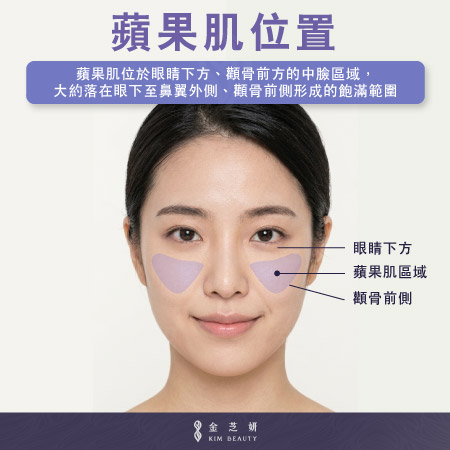 蘋果肌位置示意圖,位於眼睛下方、顴骨前側的中臉區域