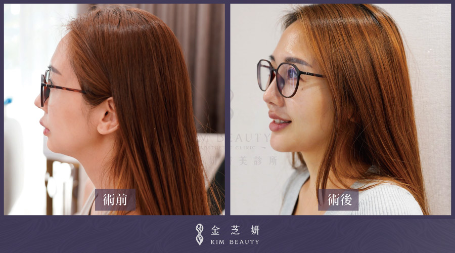 3D列印下巴二次調整術前術後比較－正面與側面輪廓