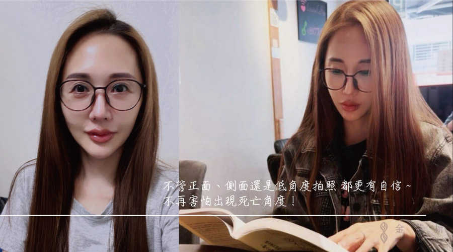 3D列印下巴術後正面臉型與下巴比例／低角度輪廓效果