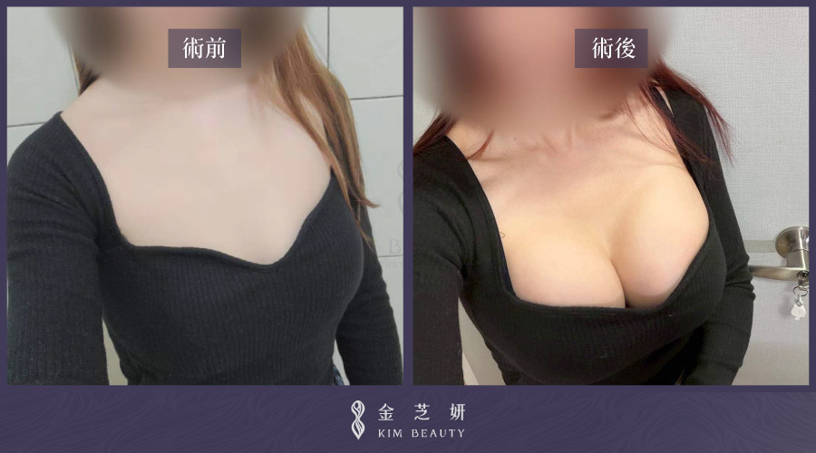 珍珠波隆乳術前術後比較－正面胸型變化
