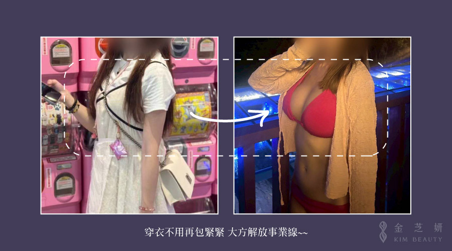珍珠波隆乳術後穿搭胸型效果